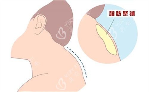 富貴包脂肪示例圖