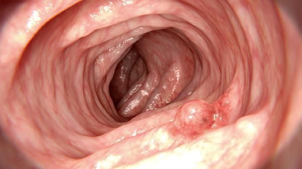 腎上有囊腫怎么回事 腎上有囊腫的常見原因介紹