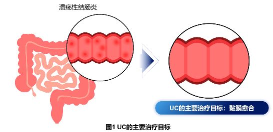 至少70% 患者隨時(shí)復(fù)發(fā)！潰瘍性結(jié)腸炎長(zhǎng)程管理至關(guān)重要