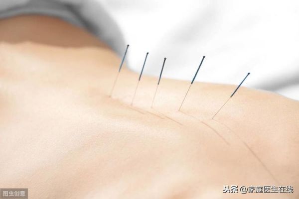 针灸可以减肥吗？适合三类人 