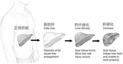 LAIFE「樂輕肝」：久坐人群需謹(jǐn)慎，脂肪肝并非肥胖專屬