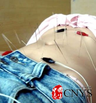 針灸減肥有風險 注意的五大誤區(qū)
