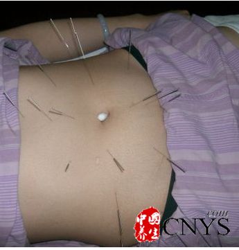 針灸減肥有風險 注意的五大誤區(qū)