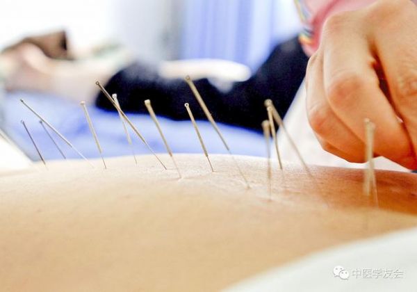 減肥不吃藥不節(jié)食 針灸減肥有神效