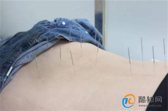 針灸減肥法有效嗎還你一個(gè)苗條迷人的身材