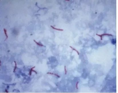 感染结核分枝杆菌=肺结核？不慌，稳住！