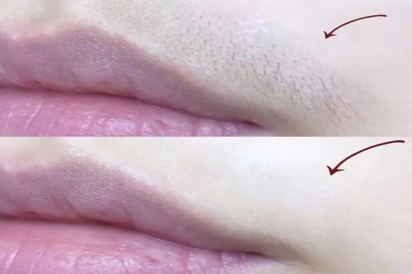 唇部胡须脱毛图