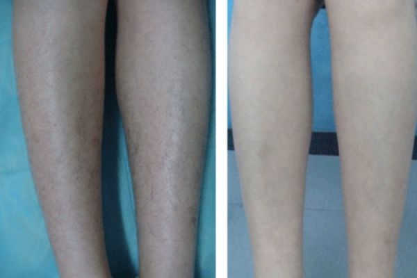 腿部脱毛前后对比图
