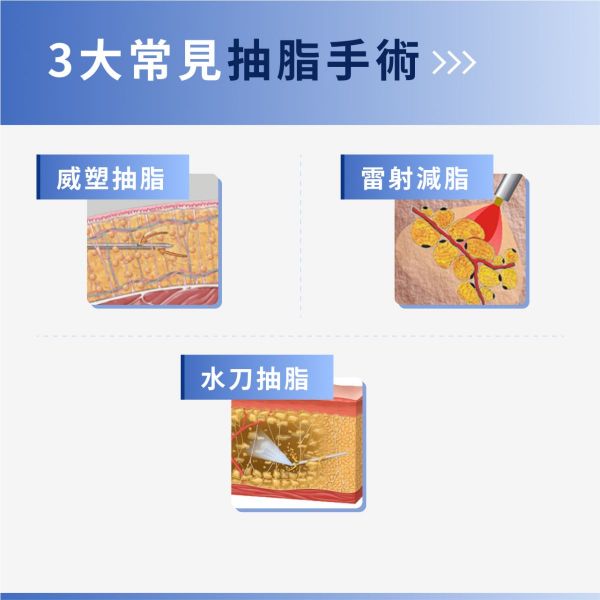 3大抽脂手術