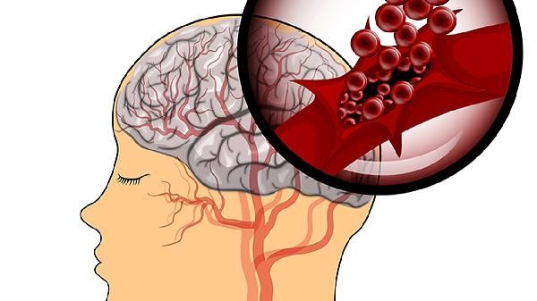 腦梗和晨練有關(guān)系？告誡：即使身體再健康，晨練時也要注意這3點(diǎn)