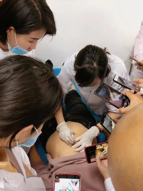 埋線手術減肥：一種安全有效的減肥方法(2)
