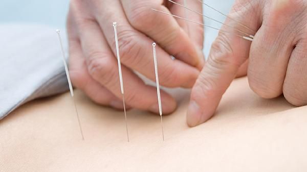 埋線減肥是局部瘦還是全身瘦呢