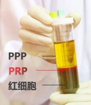 6月14日北京PRP技術(shù)骨病臨床應(yīng)用班
