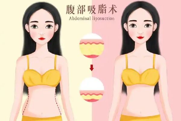 十堰亞美達(dá)吸脂塑形怎么樣?日韓技術(shù)+職業(yè)醫(yī)生團(tuán)隊打造身材