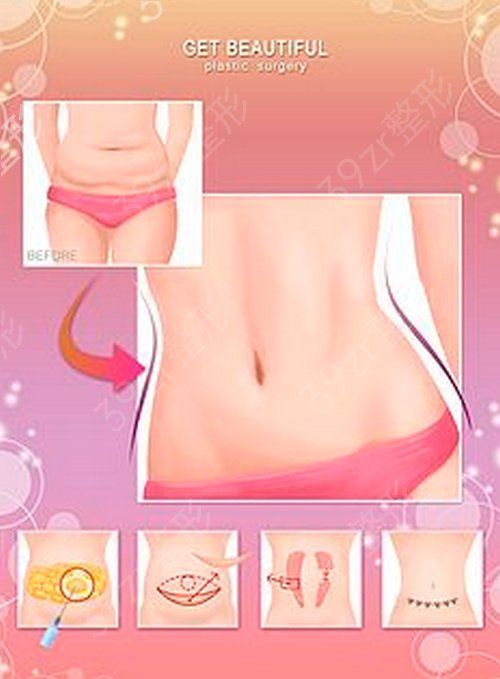 腰腹部抽脂后腫脹如何消退—術后護理重點