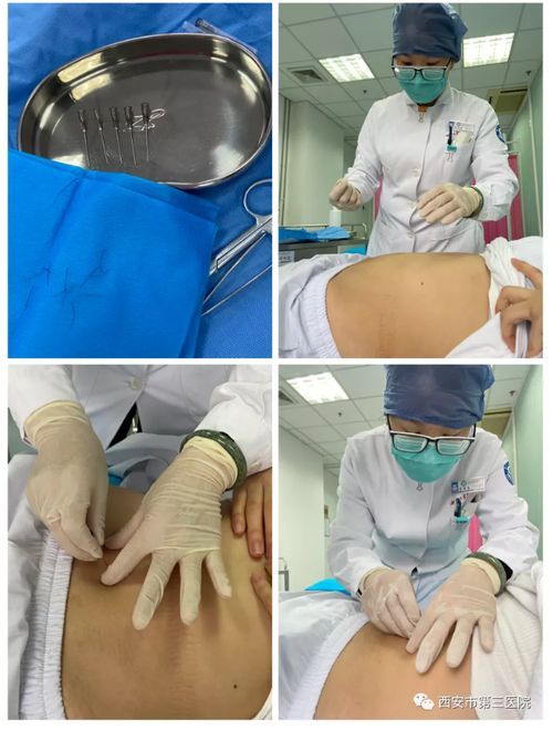 西安那家埋線減肥醫(yī)院好？