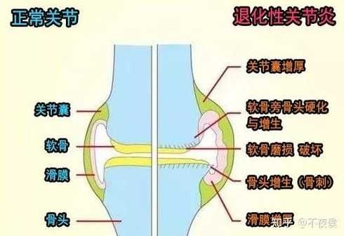 如何有效保护膝盖？预防膝盖损伤方法有哪些？ 第1张