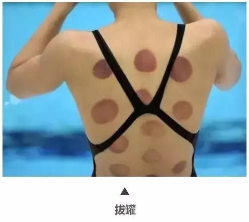 拔罐雖好并非人人都適宜，怎樣合理根據(jù)體質(zhì)來拔罐？