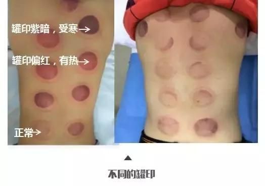 拔罐雖好并非人人都適宜，怎樣合理根據(jù)體質(zhì)來拔罐？
