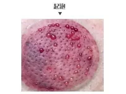 拔罐雖好并非人人都適宜，怎樣合理根據(jù)體質(zhì)來拔罐？
