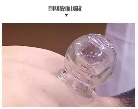拔罐雖好并非人人都適宜，怎樣合理根據(jù)體質(zhì)來拔罐？