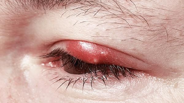 消肿的草药有哪些