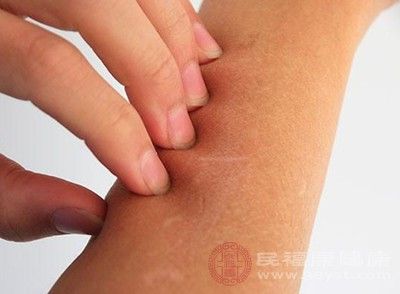 皮肤干燥、粗糙、脱屑