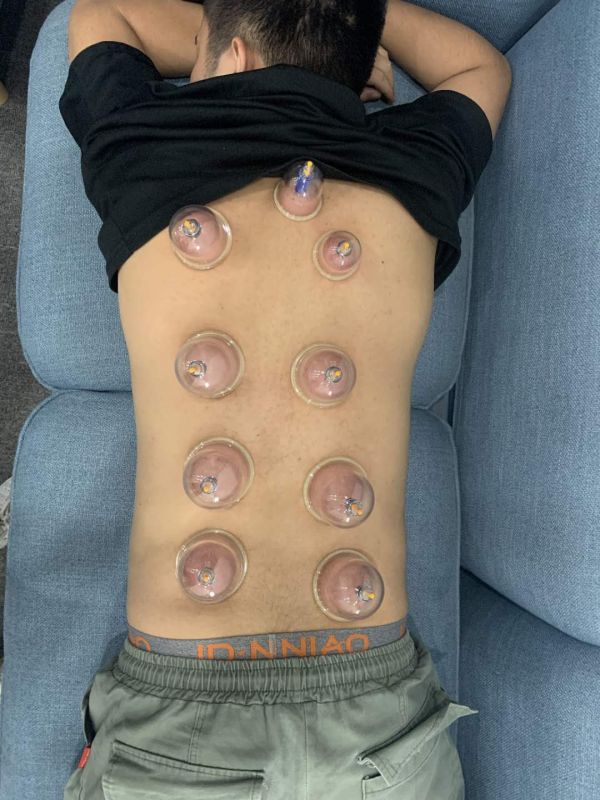 想要健康减肥，拔罐不能少10