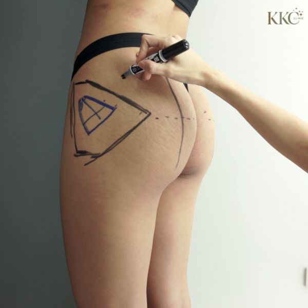 มุมมองระยะใกล้ของสะโพกผู้ป่วยที่ KKC Clinic พร้อมกับกำลังวาดเส้นเครื่องหมายเตรียมความพร้อมสำหรับการฉีดฟิลเลอร์สะโพก