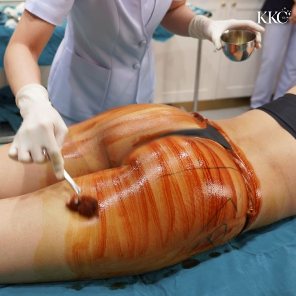 ผู้ป่วยที่ KKC Clinic กำลังนอนคว่ำในขณะที่พยาบาลทายาฆ่าเชื้อสีแดงบริเวณสะโพกเพื่อเตรียมความพร้อมสำหรับการฉีดฟิลเลอร์