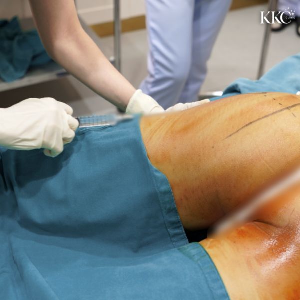 พยาบาลที่ KKC Clinic กำลังฉีดฟิลเลอร์บริเวณสะโพกของผู้ป่วยในระหว่างขั้นตอนการฉีดฟิลเลอร์ ผู้ป่วยนอนคว่ำและคลุมด้วยผ้าปลอดเชื้อ