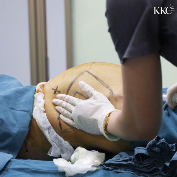 แพทย์ที่ KKC Clinic กำลังนวดบริเวณสะโพกของผู้ป่วยหลังจากฉีดฟิลเลอร์แล้ว มีเส้นเครื่องหมายก่อนการรักษาปรากฏบนผิวหนังของผู้ป่วย และผู้ป่วยนอนคว่ำ