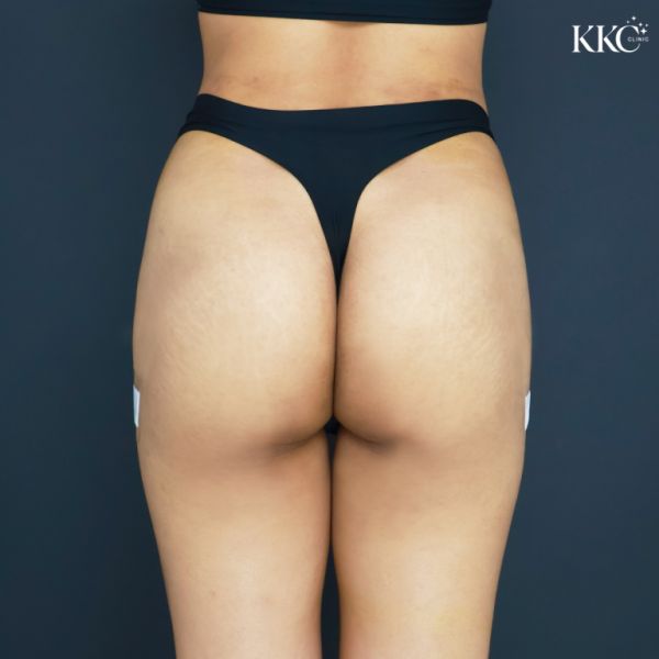 ภาพด้านหลังของสะโพกผู้ป่วยหลังจากได้รับการฉีดฟิลเลอร์สะโพกที่ KKC Clinic ผู้ป่วยสวมกางเกงชั้นในสีดำและมีพลาสเตอร์ปิดแผลเล็ก ๆ ที่สะโพกทั้งสองข้าง