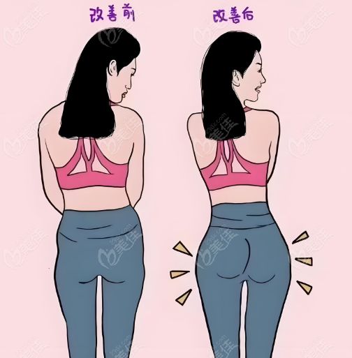 赵军舰吸脂填臀实例前后对比成效显著
