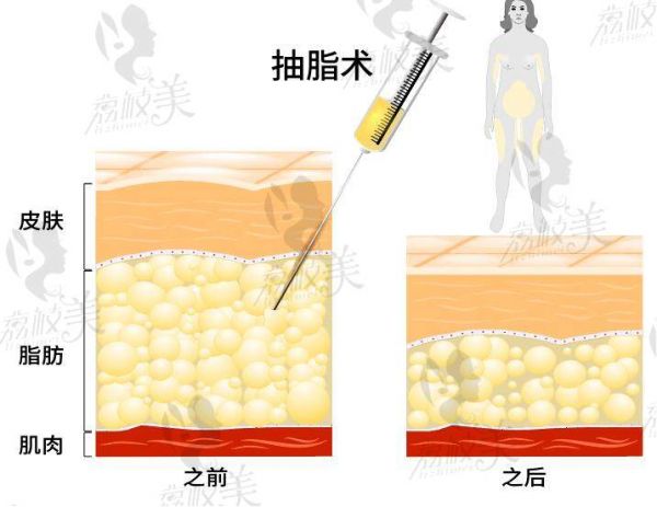 成都艾米麗與軍大吸脂對比：醫(yī)生實(shí)力、抽脂技術(shù)、價(jià)格哪家更勝一籌？