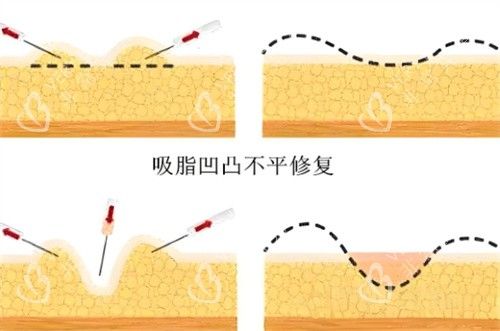 吸脂术后皮肤凹凸不平