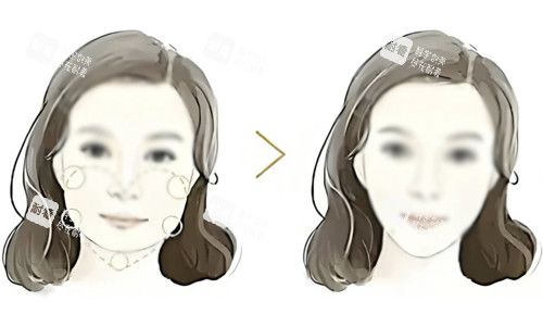 面部吸脂对比