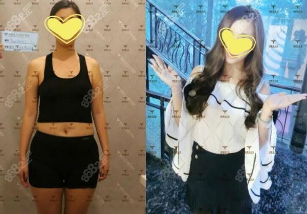 北京润美玉之光朱金成全身吸脂效果图片