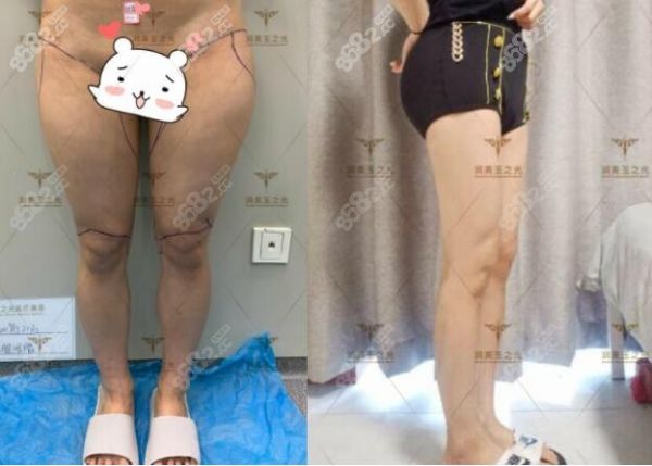 北京润美玉之光张红芳5G天使光雕吸脂瘦大腿效果对比图