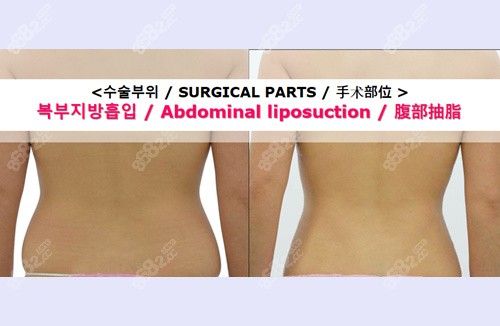 韩国必当归柳济圣腰腹吸脂