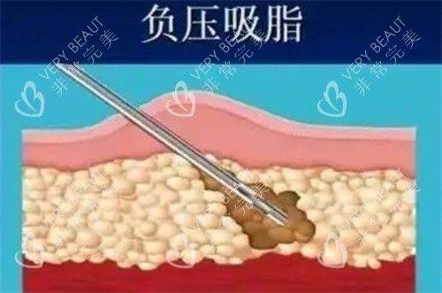负压吸脂