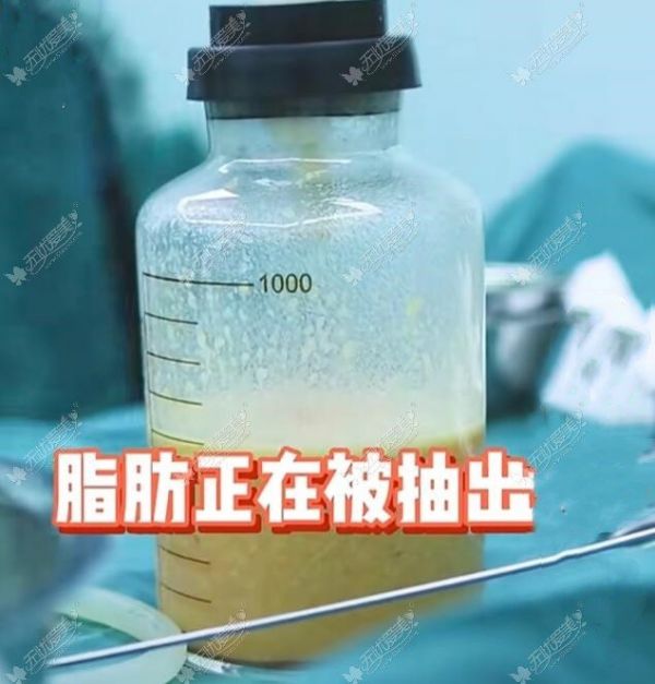 吸脂吸出来的脂肪图片