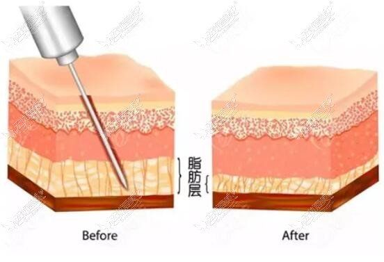 吸脂手术后脂肪层对比变化图片