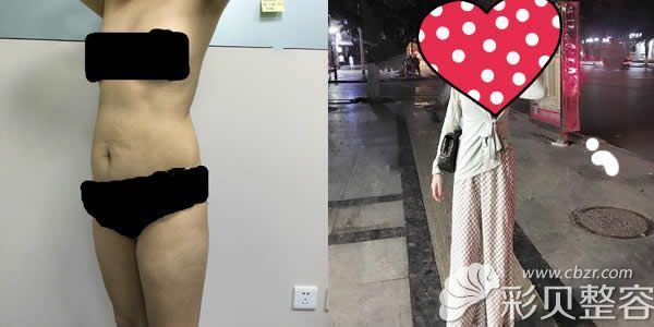 上海华美何斌全身抽脂40斤案例效果图
