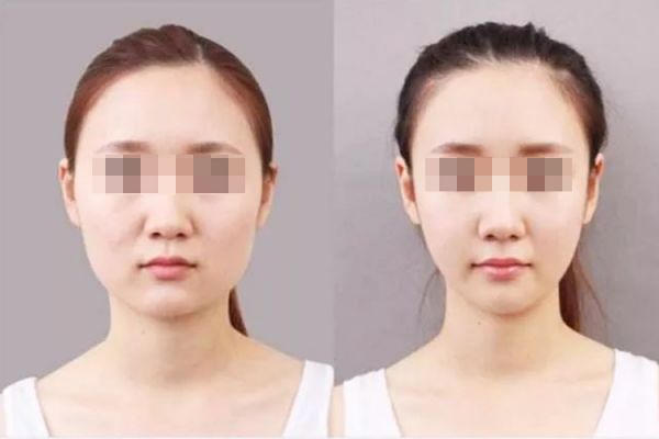 面部吸脂做完10天对比图