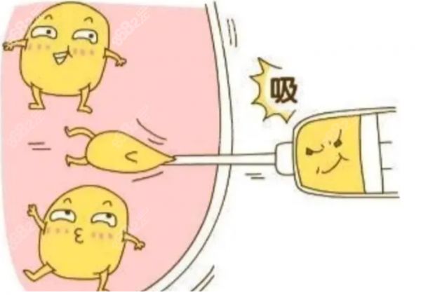 杨灿龙医生吸脂