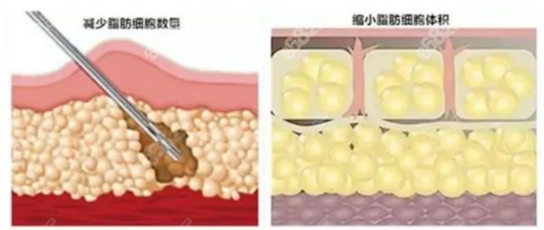 杨灿龙医生吸脂