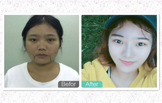 面部吸脂对比照片 6组真人脸部抽脂效果欣赏 