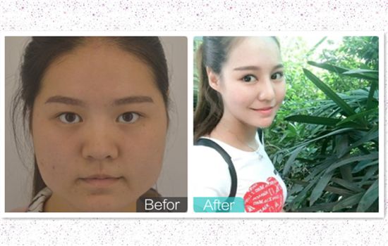 面部吸脂对比照片 6组真人脸部抽脂效果欣赏 