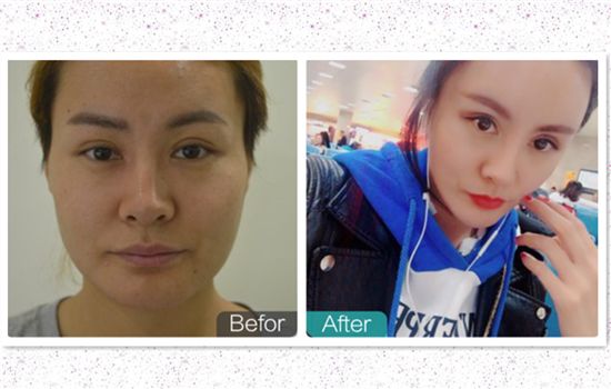 面部吸脂对比照片 6组真人脸部抽脂效果欣赏 